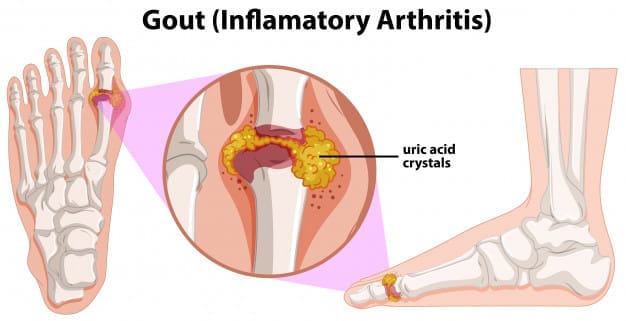 gout 3 an illustration of people having gout | BookDoc