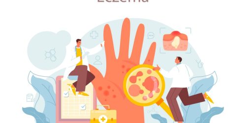 Eczema-Children-Main